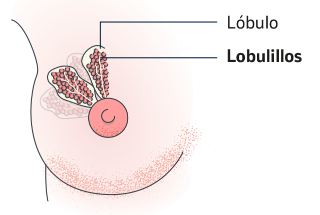 Carcinoma lobulillar invasivo